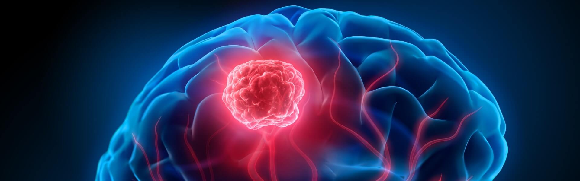 what is brain tumor/ब्रेन ट्यूमर म्हणजे काय