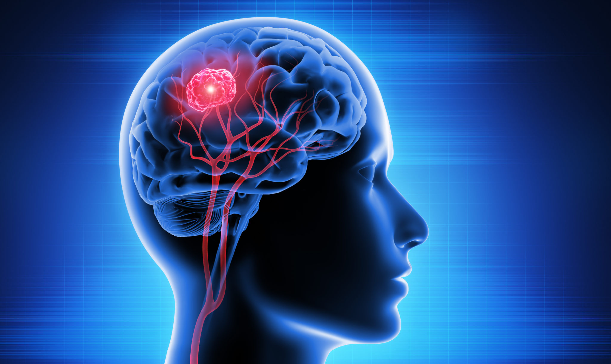 Quick brain tumor