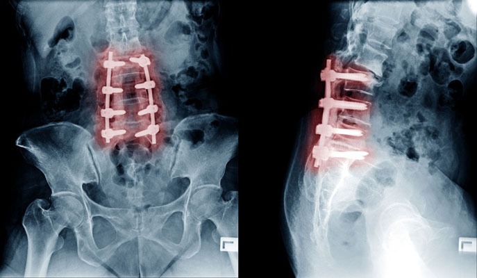 spinal fusion surgery cost