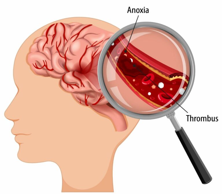 Thrombolysis
