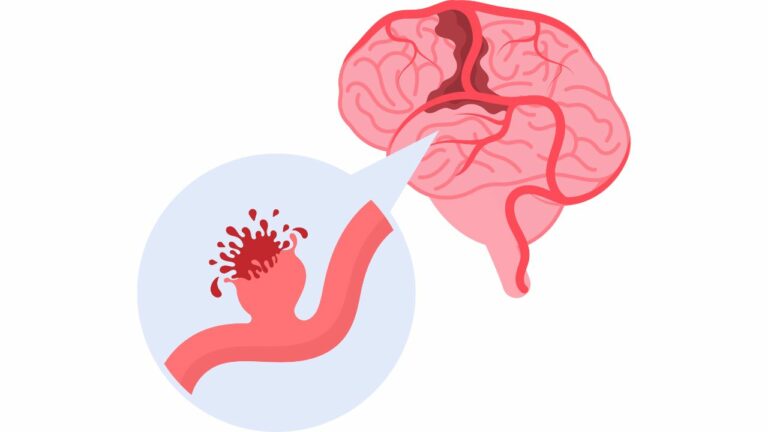 Cerebral Vascular Aneurysms- Symptoms and Treatment Options